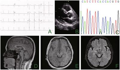 A case report of Andersen-Tawil syndrome misdiagnosed with myodystrophy